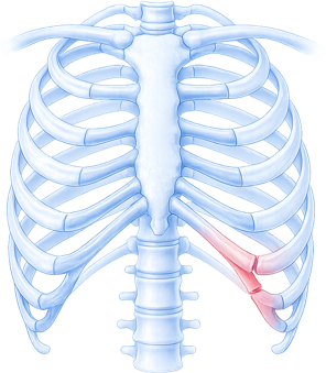 Illustration of slipping rib syndrome
